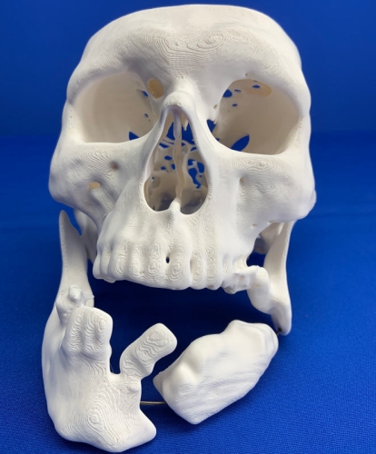 Personal Injury Lawsuit - Skull Broken Jaw